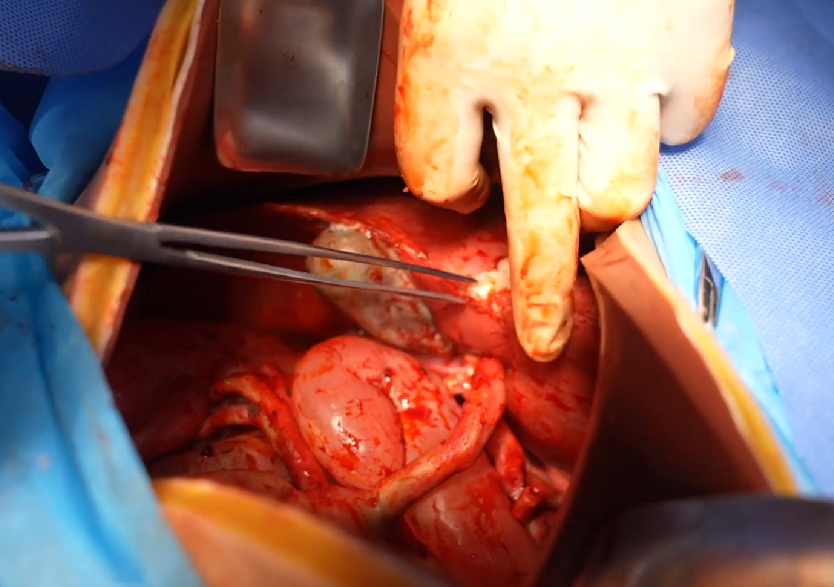 胸腹部損傷控制手術(shù)模擬人系統3.0